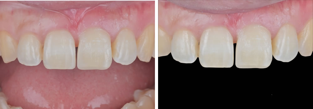 ダイレクトボンディングの実施