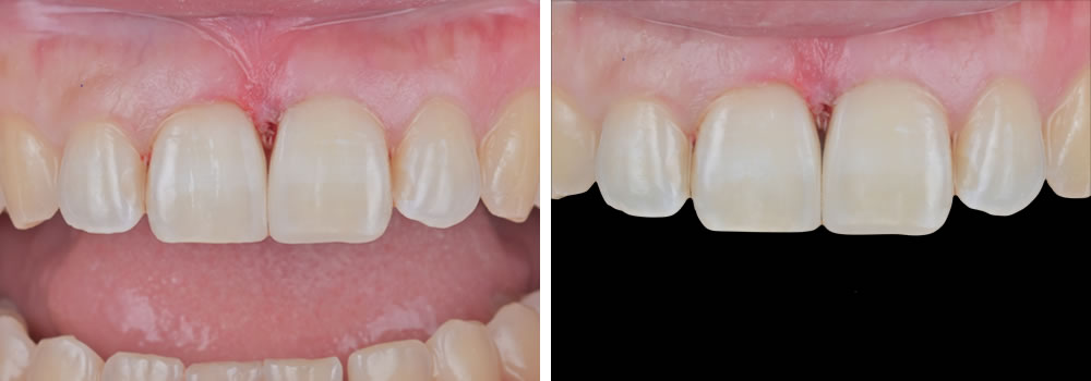 ダイレクトボンディングの実施