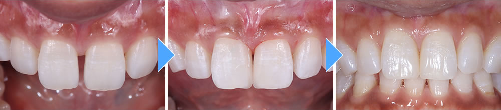 ダイレクトボンディングで前歯の隙間を改善した症例