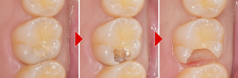 虫歯の除去
