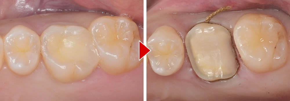 支台築造・型取り
