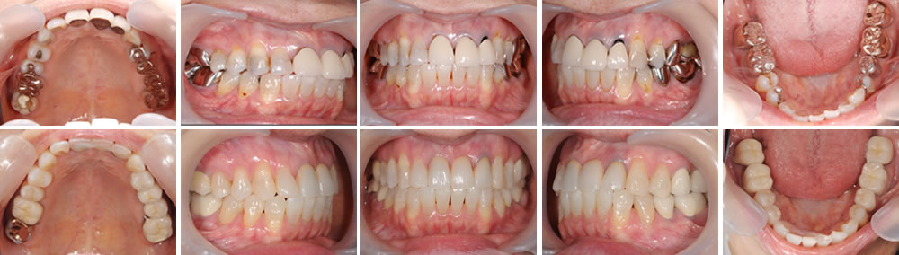 全顎的な歯科治療（フルマウス）の症例