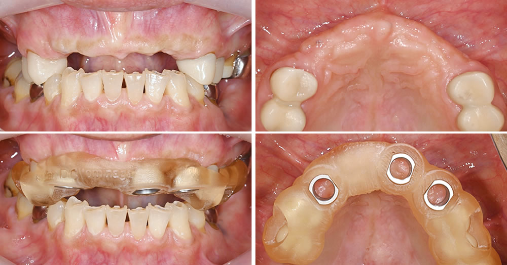インプラント治療の実施