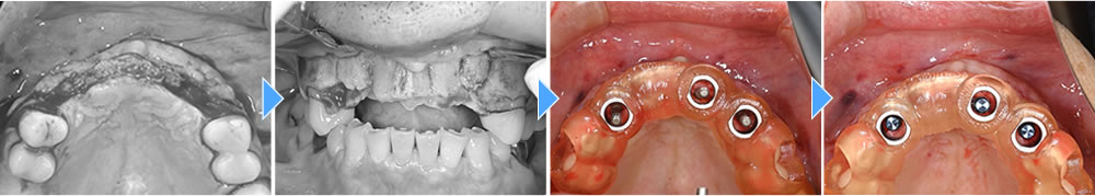 インプラント治療の実施