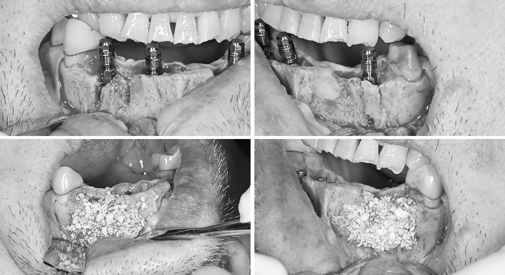 インプラント治療の実施
