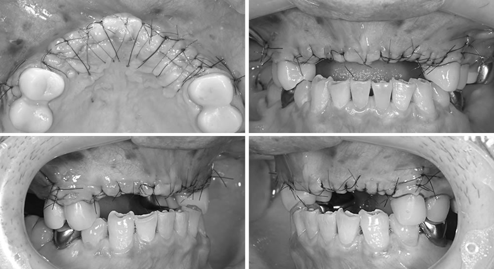 インプラント治療の実施