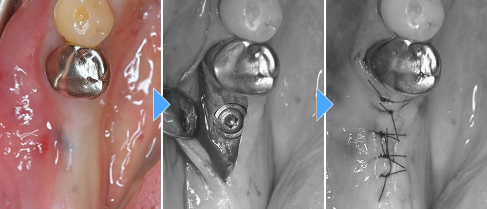 インプラント治療の実施