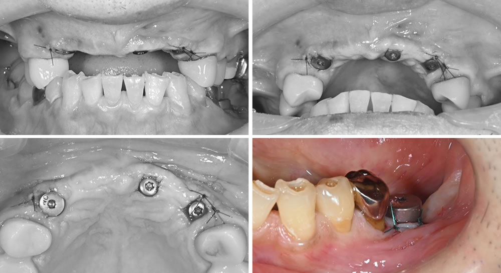 上部構造(かぶせ物)の型取り