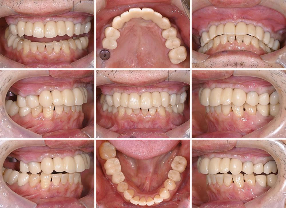 型取り~仮歯の装着