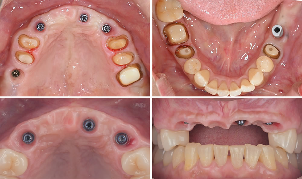 最終的な上部構造の型取り