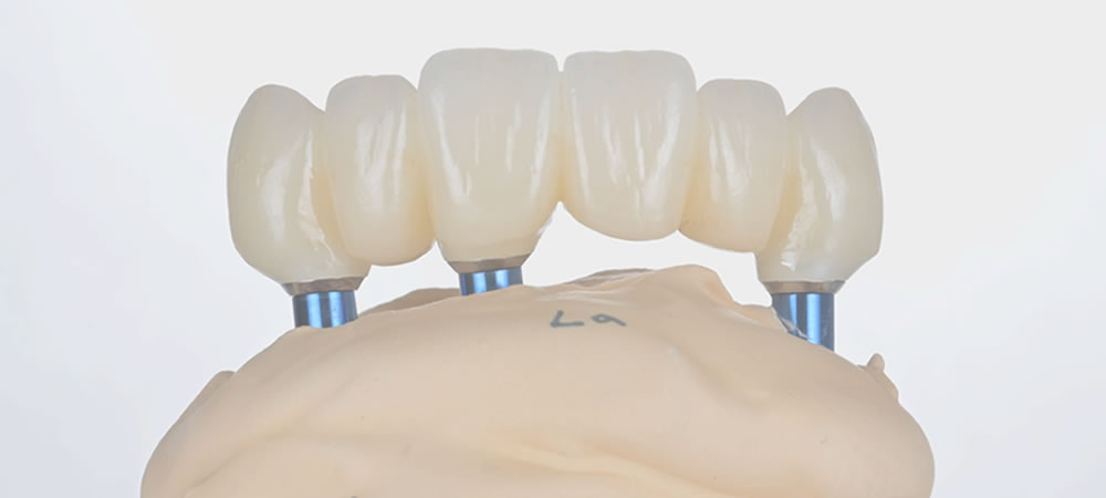 完成した最終的な上部構造(人工歯)