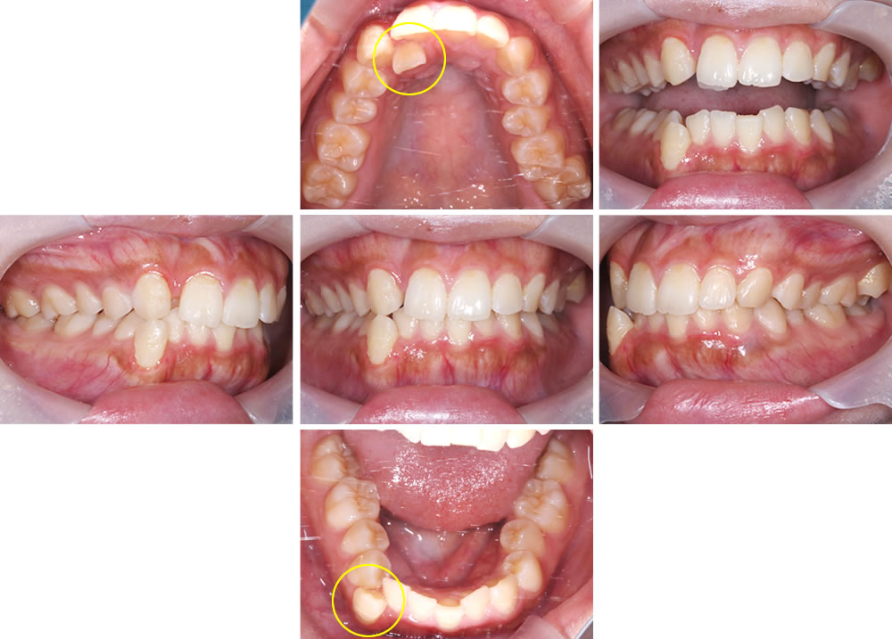 初診時の口腔内
