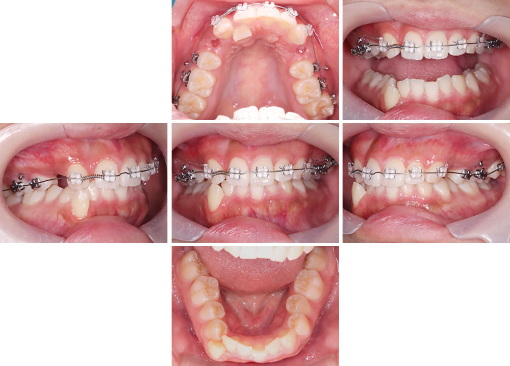 ワイヤー矯正の実施