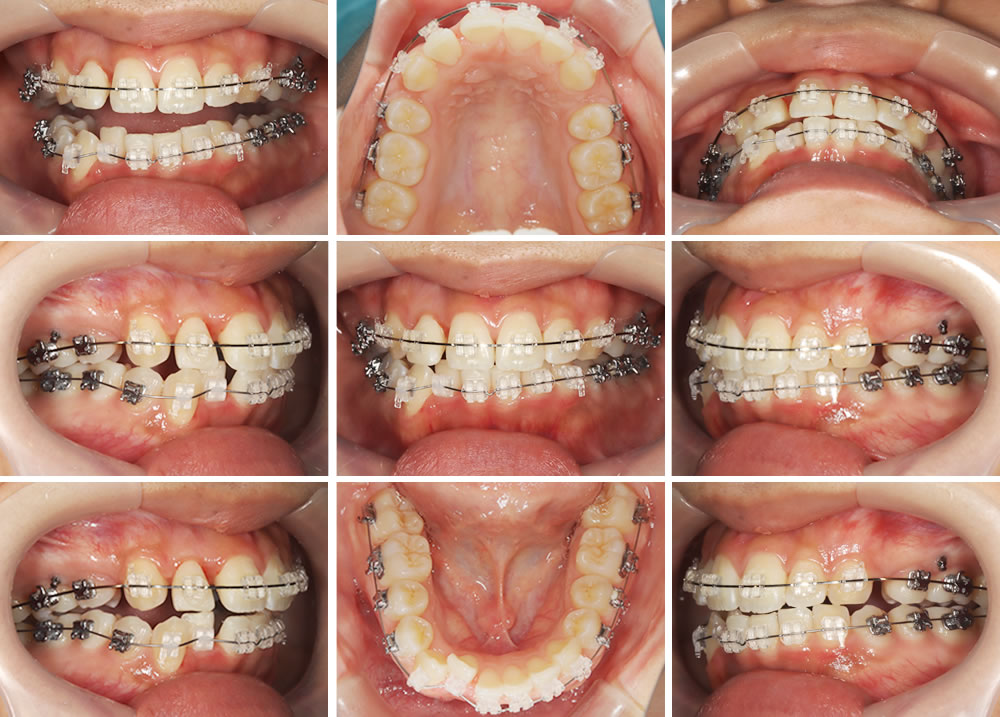 ワイヤー矯正の実施