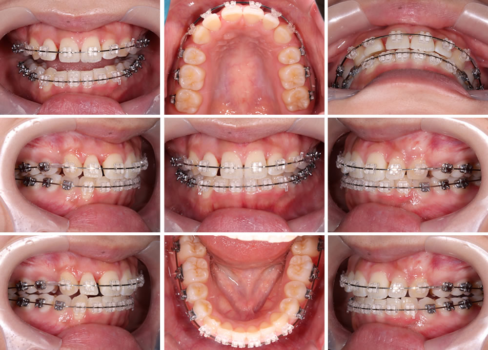 ワイヤー矯正の実施