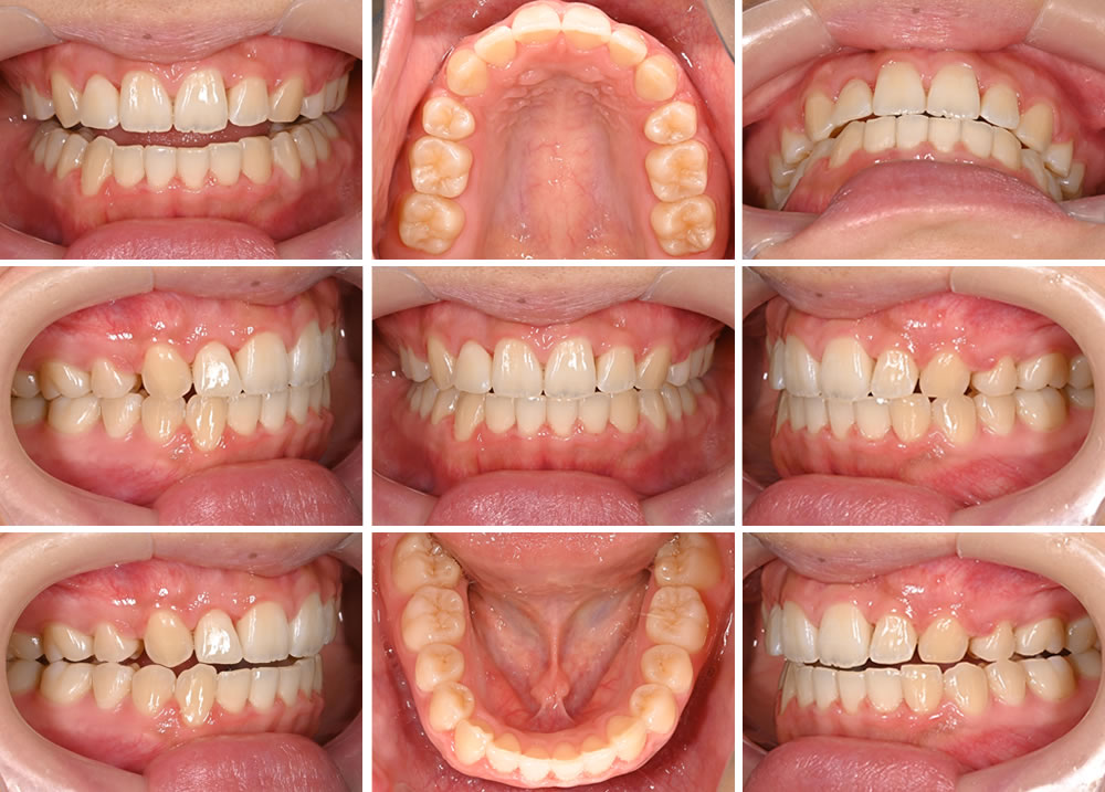 マウスピース矯正の実施