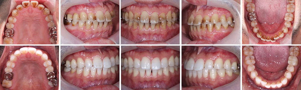 予防歯科（クリーニング）の症例