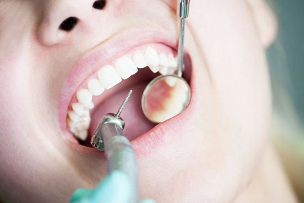 虫歯治療・精密根管治療