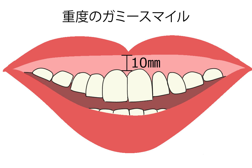 重度のガミースマイル