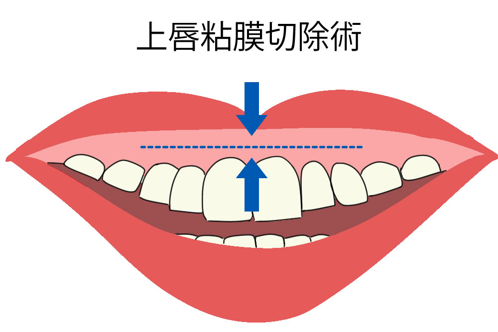 上唇粘膜切除術