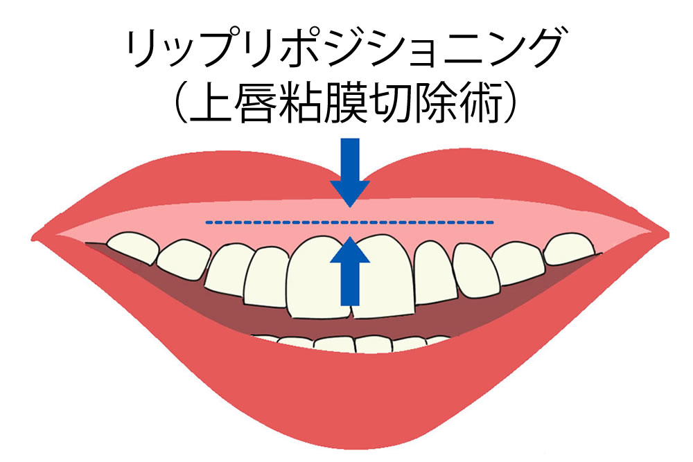 上唇粘膜切除術