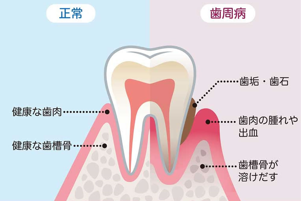 歯周病の症状や原因